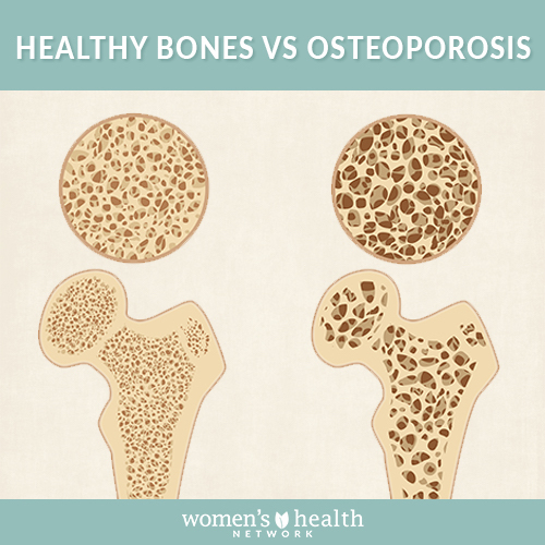 Healthy bones vs osteoporosis bones.